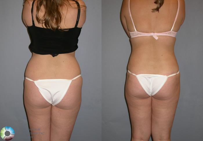 Before & After Liposuction Case 128 View #5 in Denver, CO