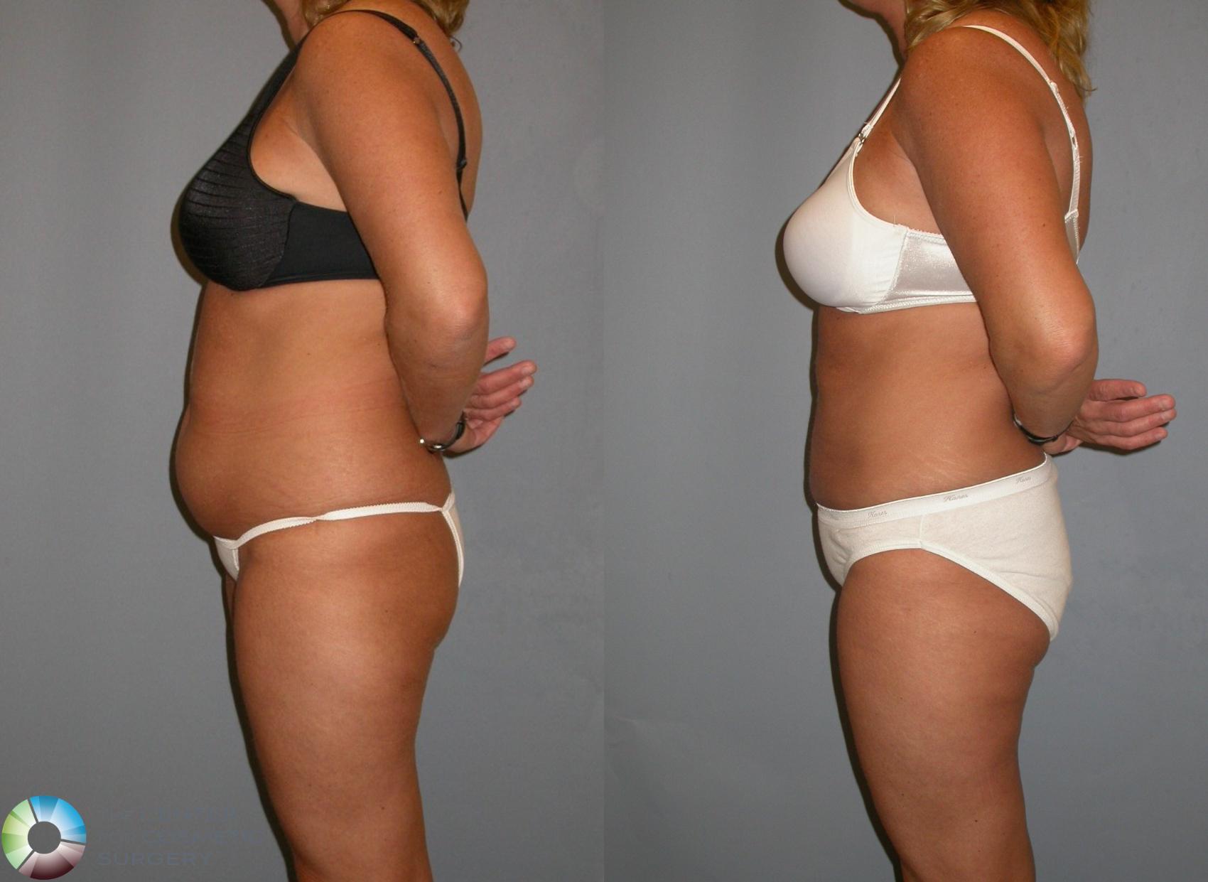 Before & After Liposuction Case 130 View #1 in Denver and Colorado Springs, CO