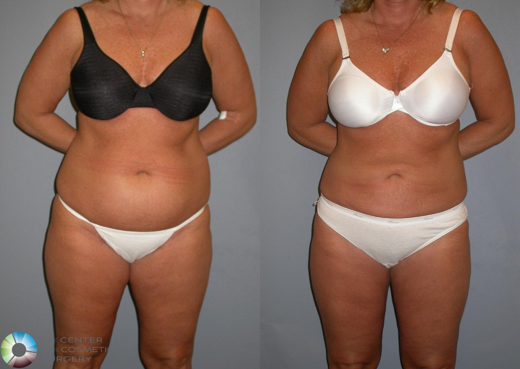 Before & After Liposuction Case 130 View #2 View in Golden, CO