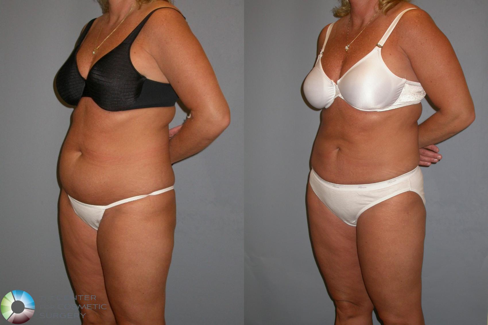 Before & After Liposuction Case 130 View #3 View in Golden, CO