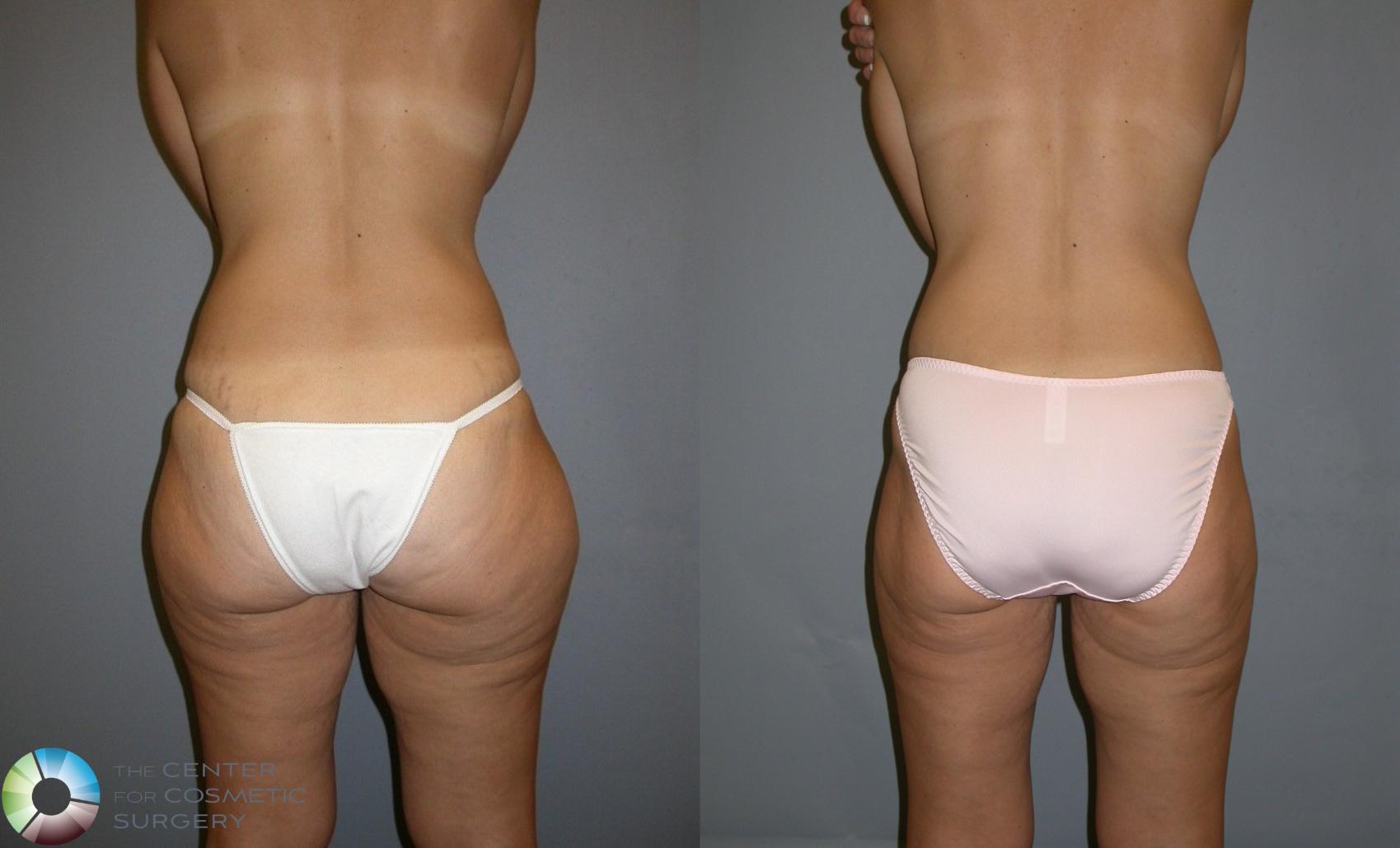 Before & After Power-assisted Liposuction Case 131 View #1 in Denver and Colorado Springs, CO