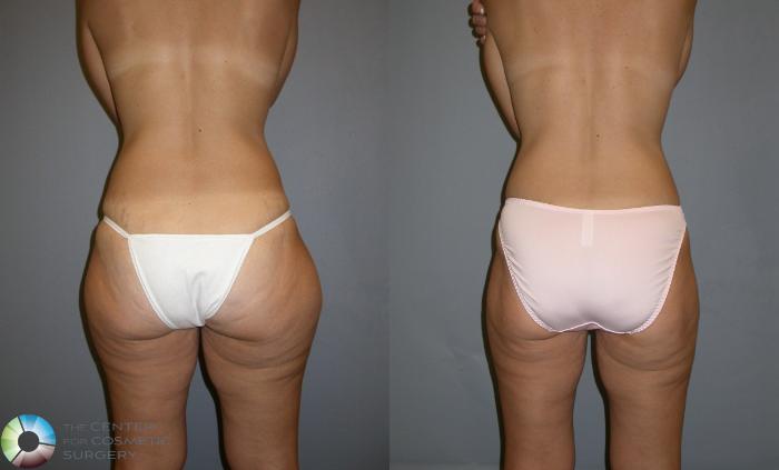 Before & After Power-assisted Liposuction Case 131 View #1 View in Golden, CO