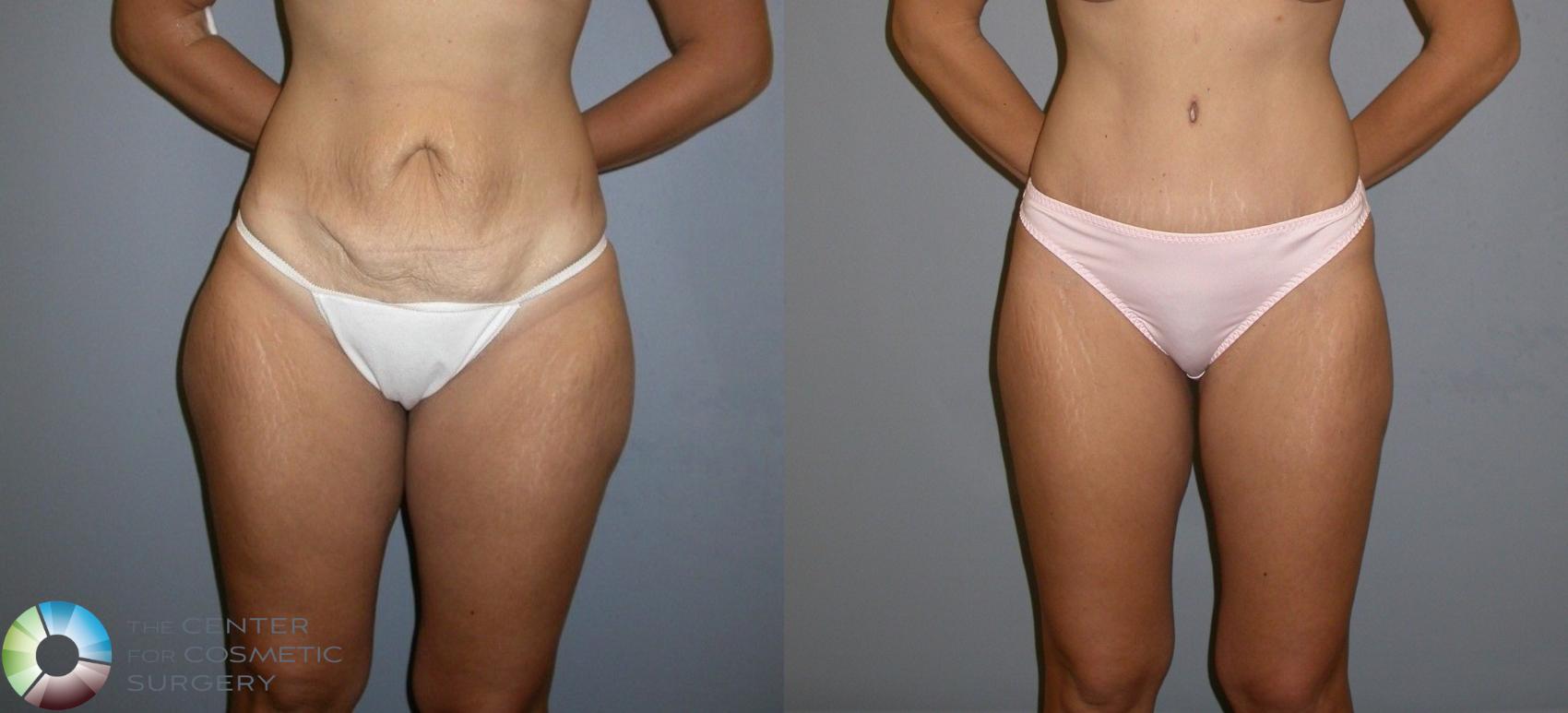 Before & After Power-assisted Liposuction Case 131 View #2 View in Denver & Golden, CO