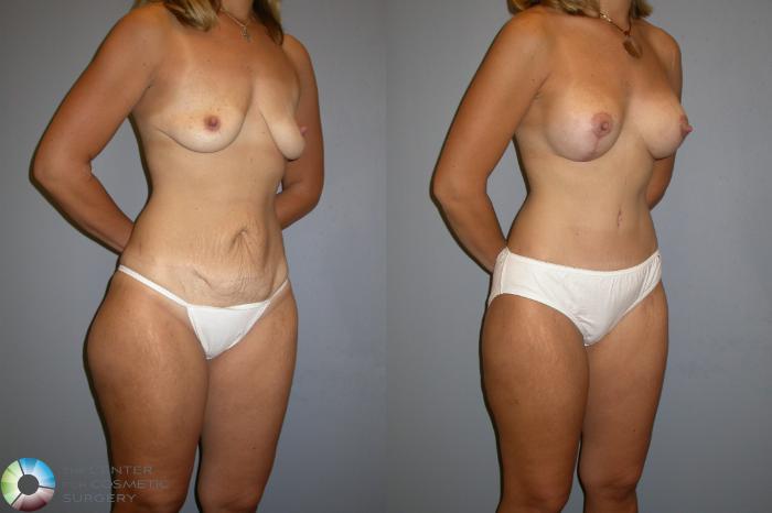 Before & After Liposuction Case 131 View #3 View in Golden, CO