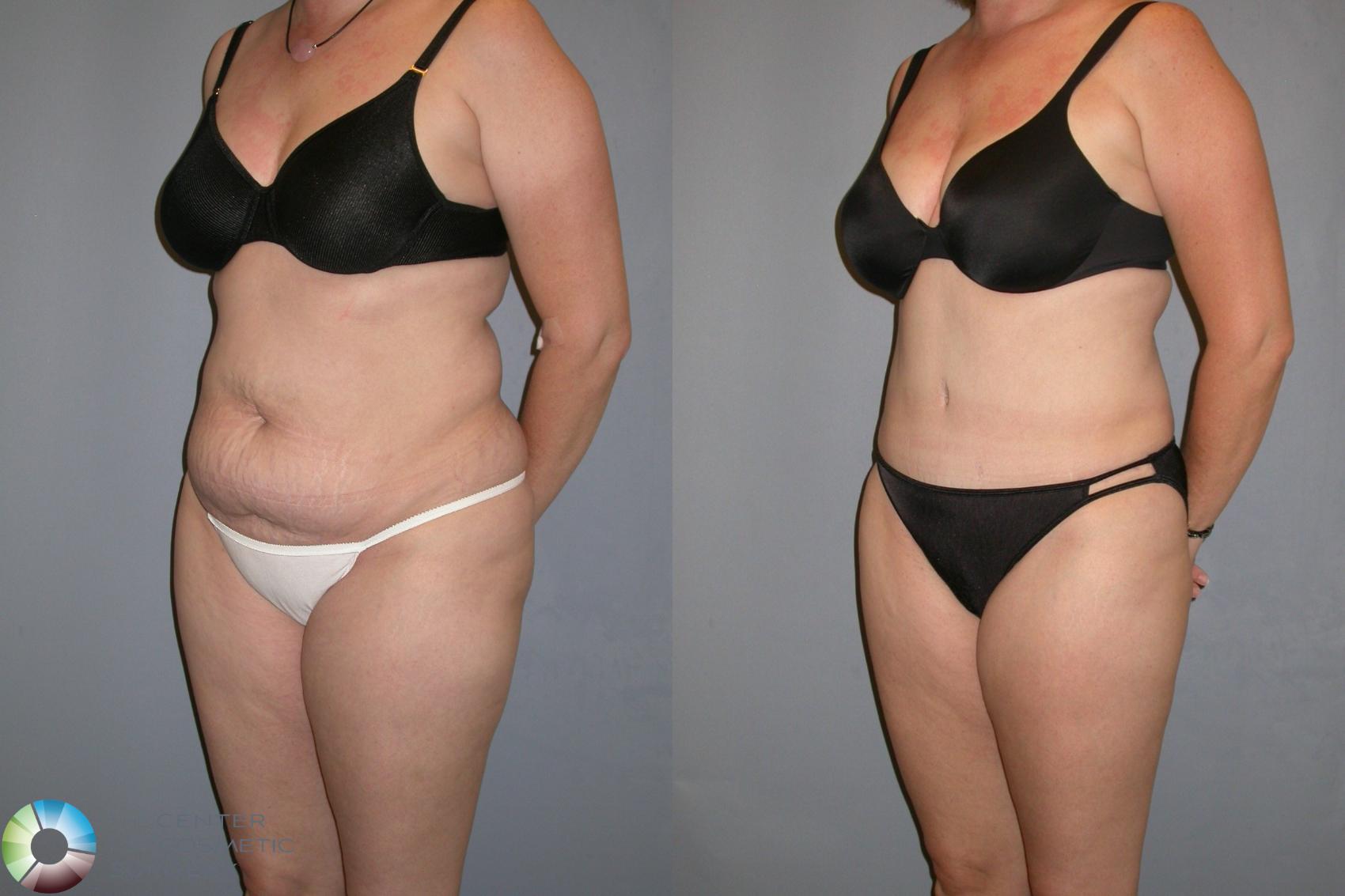 Before & After Power-assisted Liposuction Case 132 View #2 View in Denver & Golden, CO