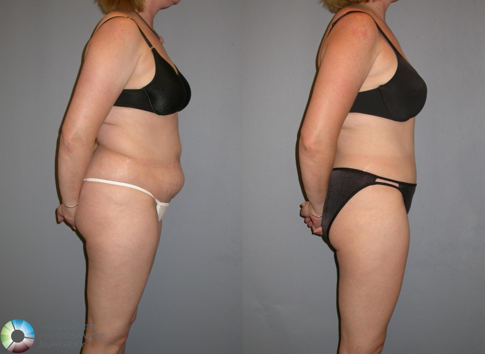 Before & After Liposuction Case 132 View #3 View in Golden, CO