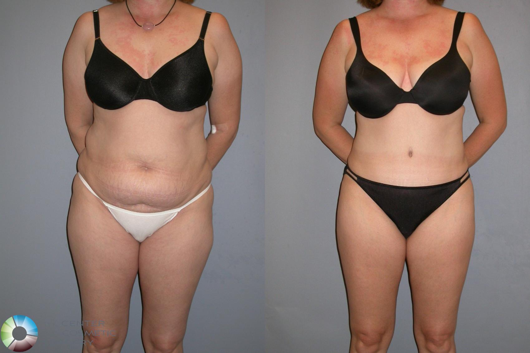 Before & After Liposuction Case 132 View #4 View in Golden, CO