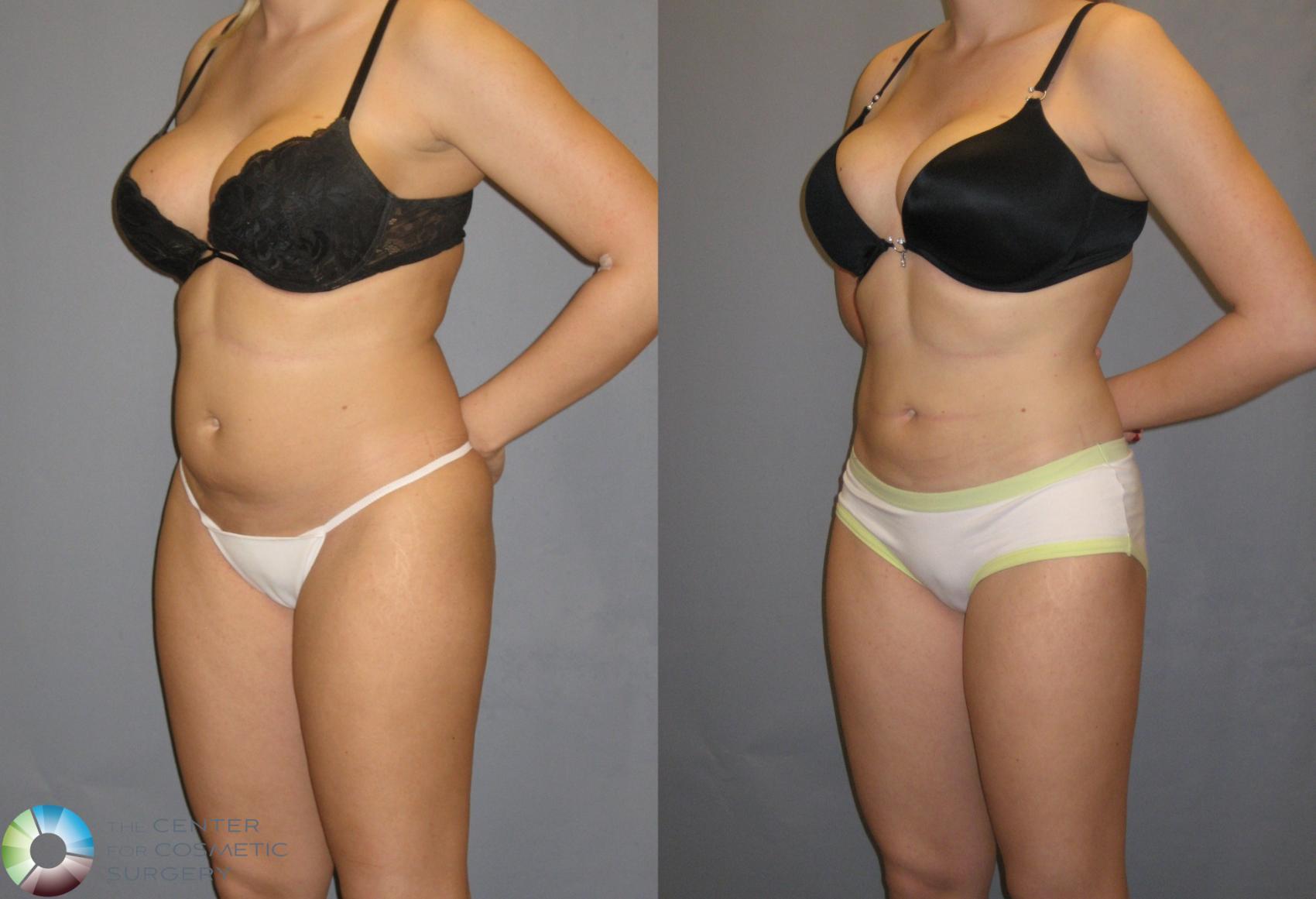 Before & After Power-assisted Liposuction Case 151 View #1 View in Golden, CO