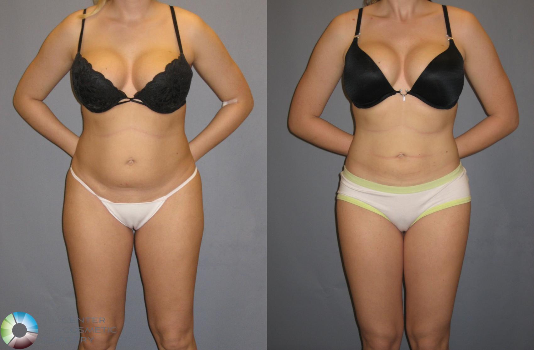 Before & After Power-assisted Liposuction Case 151 View #2 View in Denver & Golden, CO