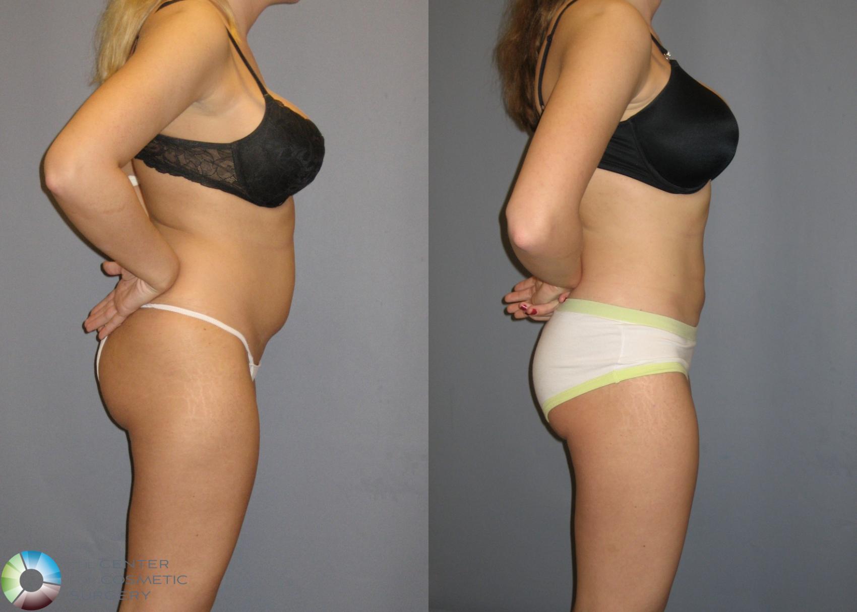 Before & After Liposuction Case 151 View #3 in Denver and Colorado Springs, CO