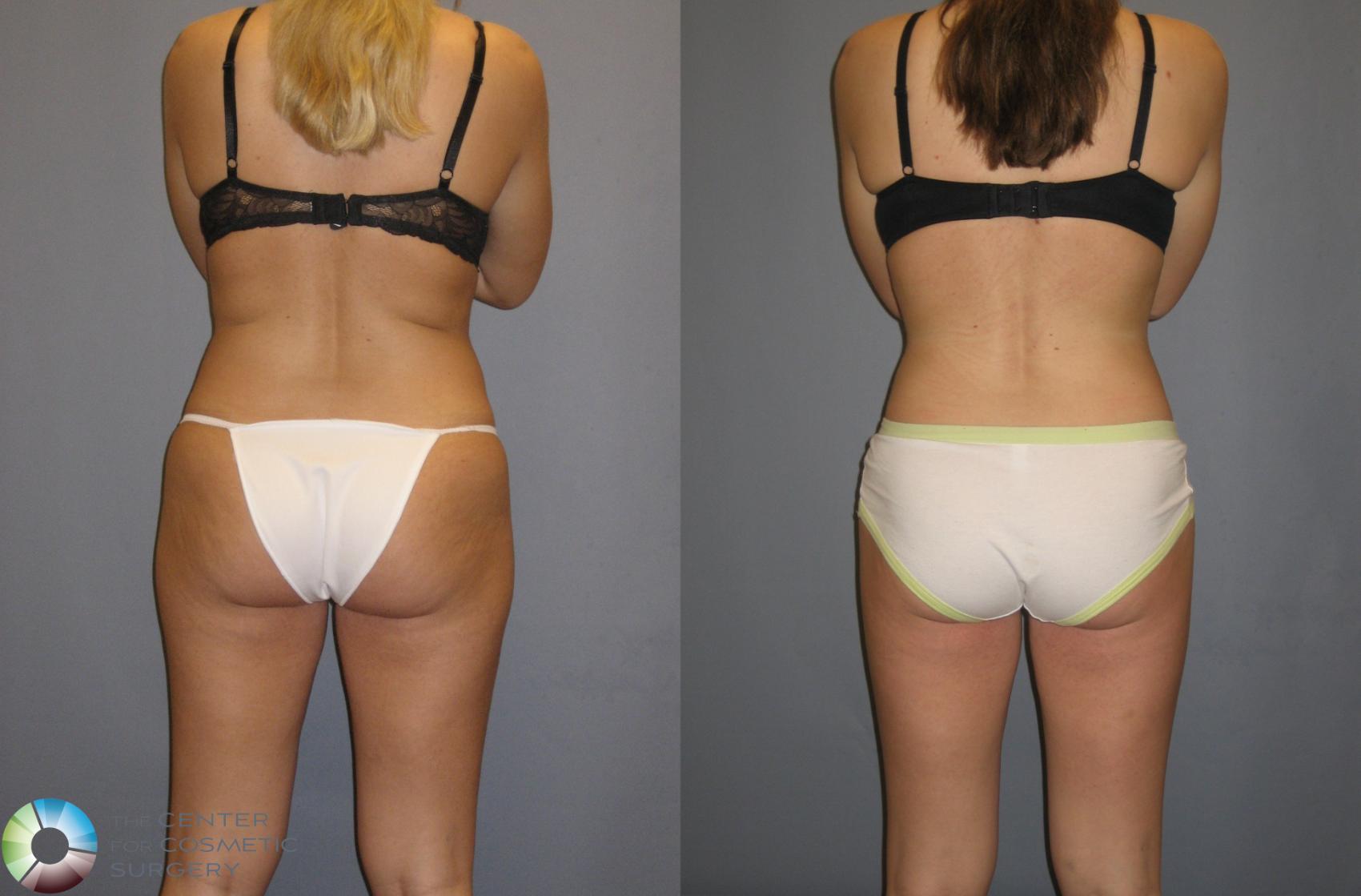 Before & After Power-assisted Liposuction Case 151 View #4 View in Denver & Golden, CO