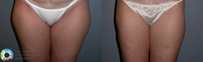 Before & After Power-assisted Liposuction Case 19 View #1 in Denver, CO
