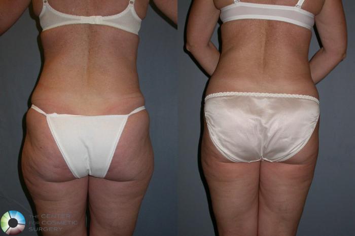Before & After Power-assisted Liposuction Case 19 View #2 in Denver, CO