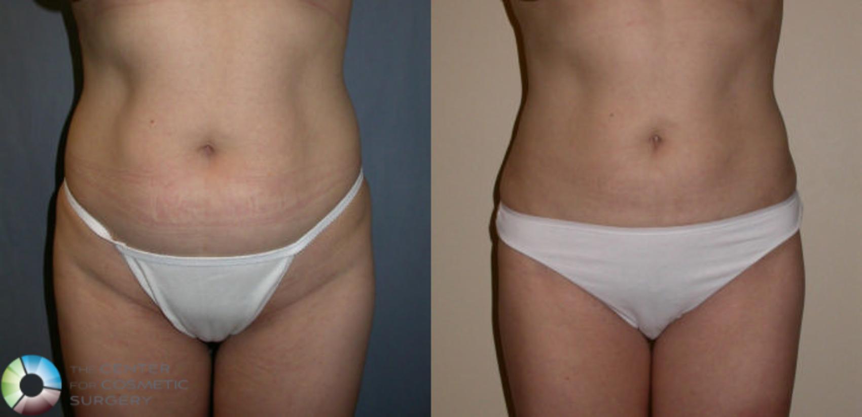 Before & After Liposuction Case 30 View #1 in Denver and Colorado Springs, CO