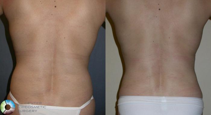 Before & After Liposuction Case 30 View #2 in Denver and Colorado Springs, CO