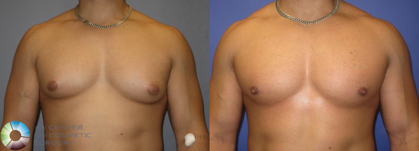 Before & After Male Breast Reduction (Gynecomastia) Case 301 View #1 in Denver and Colorado Springs, CO