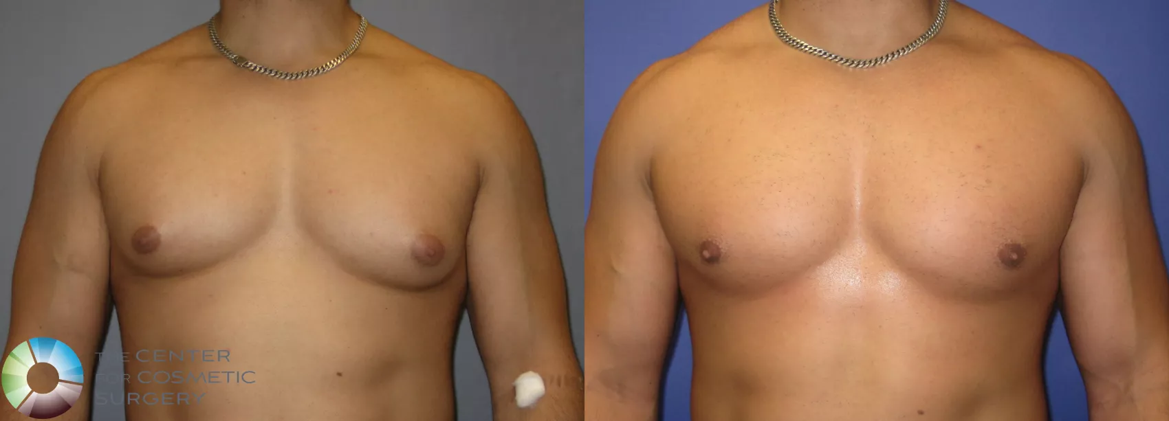 30 year old male with enlargement of breast tissue on both sides.  Combination of Liposuction and breast tissue excision was done to achieve  normal chest contour. - Dr Jain