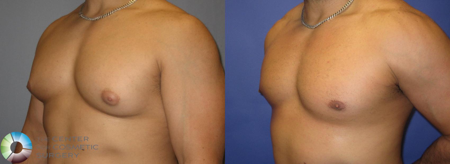 Before & After Liposuction Case 301 View #2 View in Denver & Golden, CO