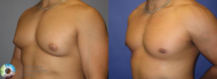 Before & After Male Breast Reduction (Gynecomastia) Case 301 View #2 View in Golden, CO