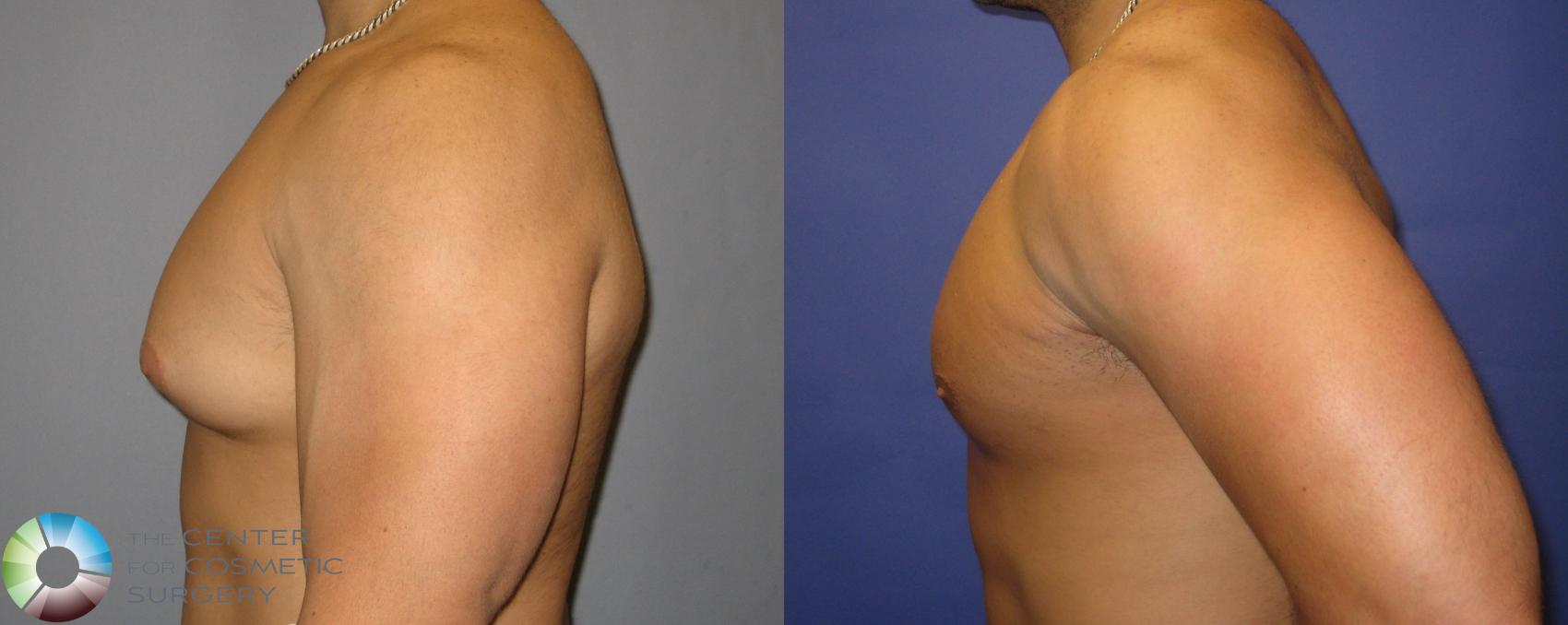 Before & After Power-assisted Liposuction Case 301 View #3 View in Denver & Golden, CO