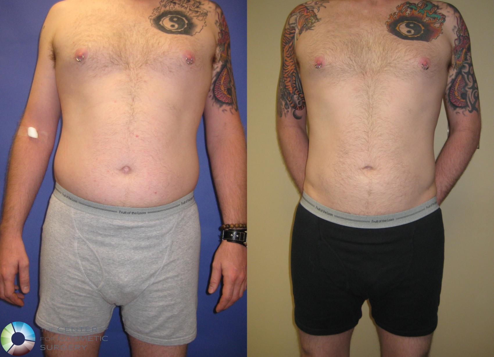 Before & After Liposuction Case 314 View #1 View in Golden, CO