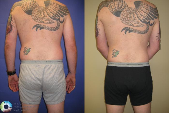 Before & After Liposuction Case 314 View #2 in Denver and Colorado Springs, CO