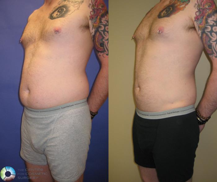 Before & After Liposuction Case 314 View #3 in Denver and Colorado Springs, CO