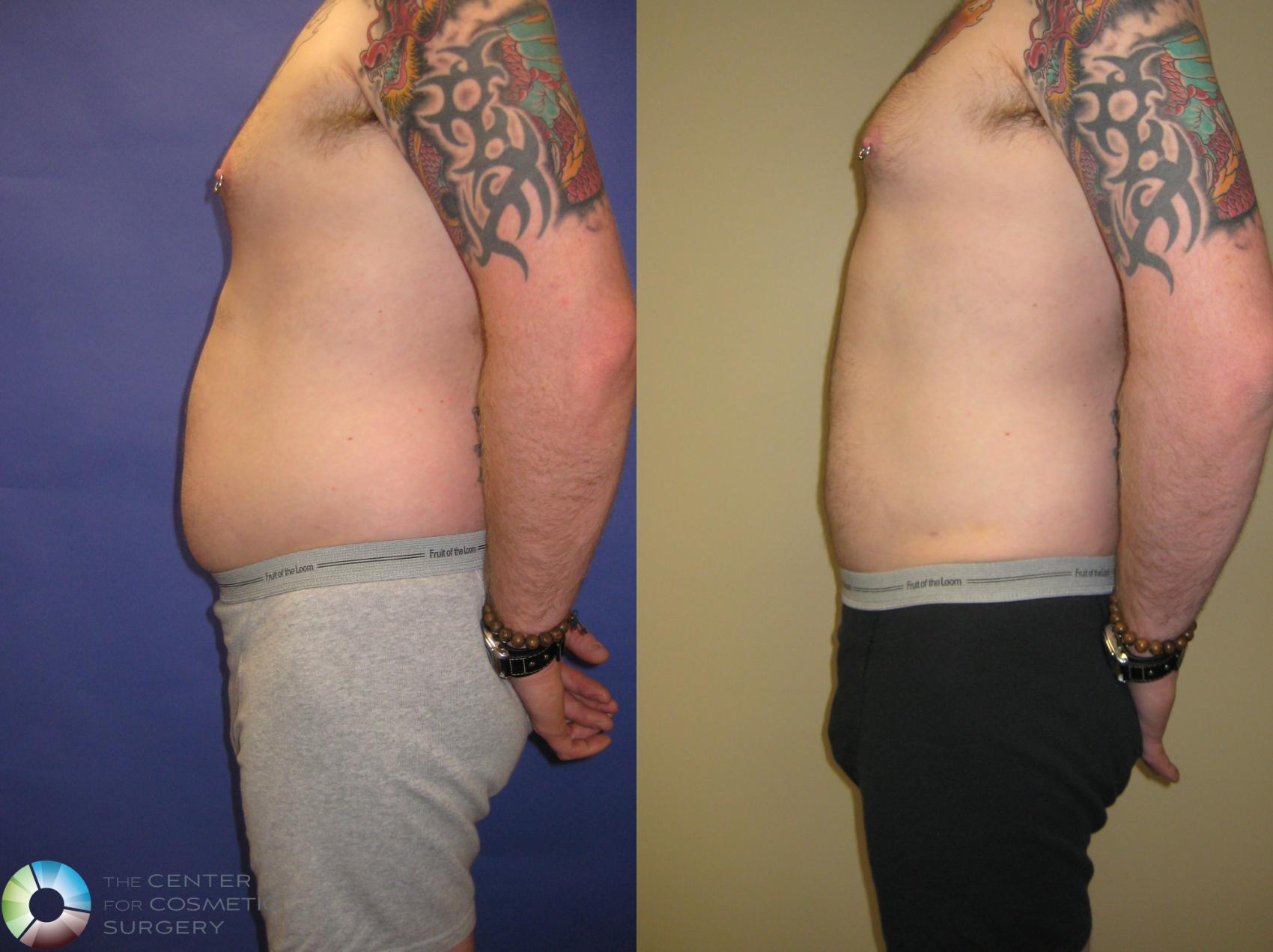 Before & After Liposuction Case 314 View #4 in Denver and Colorado Springs, CO