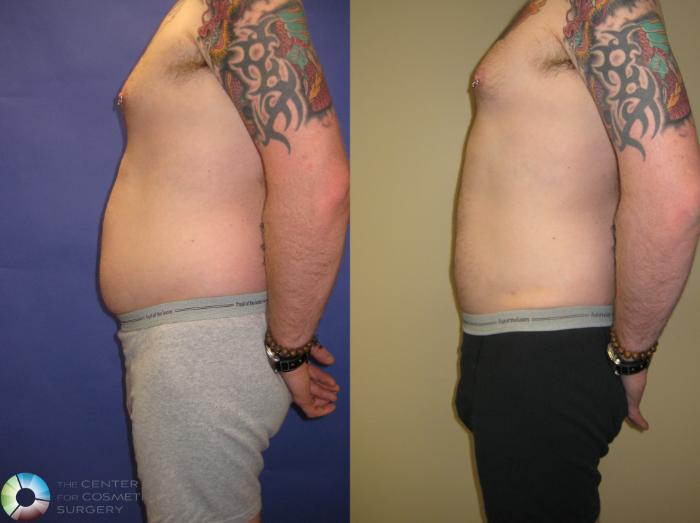 Before & After Liposuction Case 314 View #4 in Denver and Colorado Springs, CO