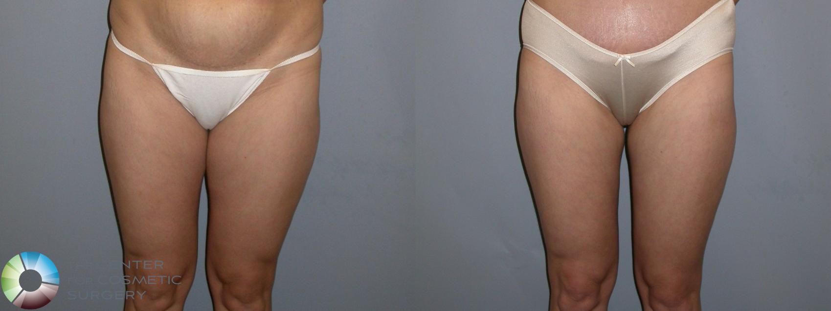 Before & After Liposuction Case 327 View #1 in Denver and Colorado Springs, CO