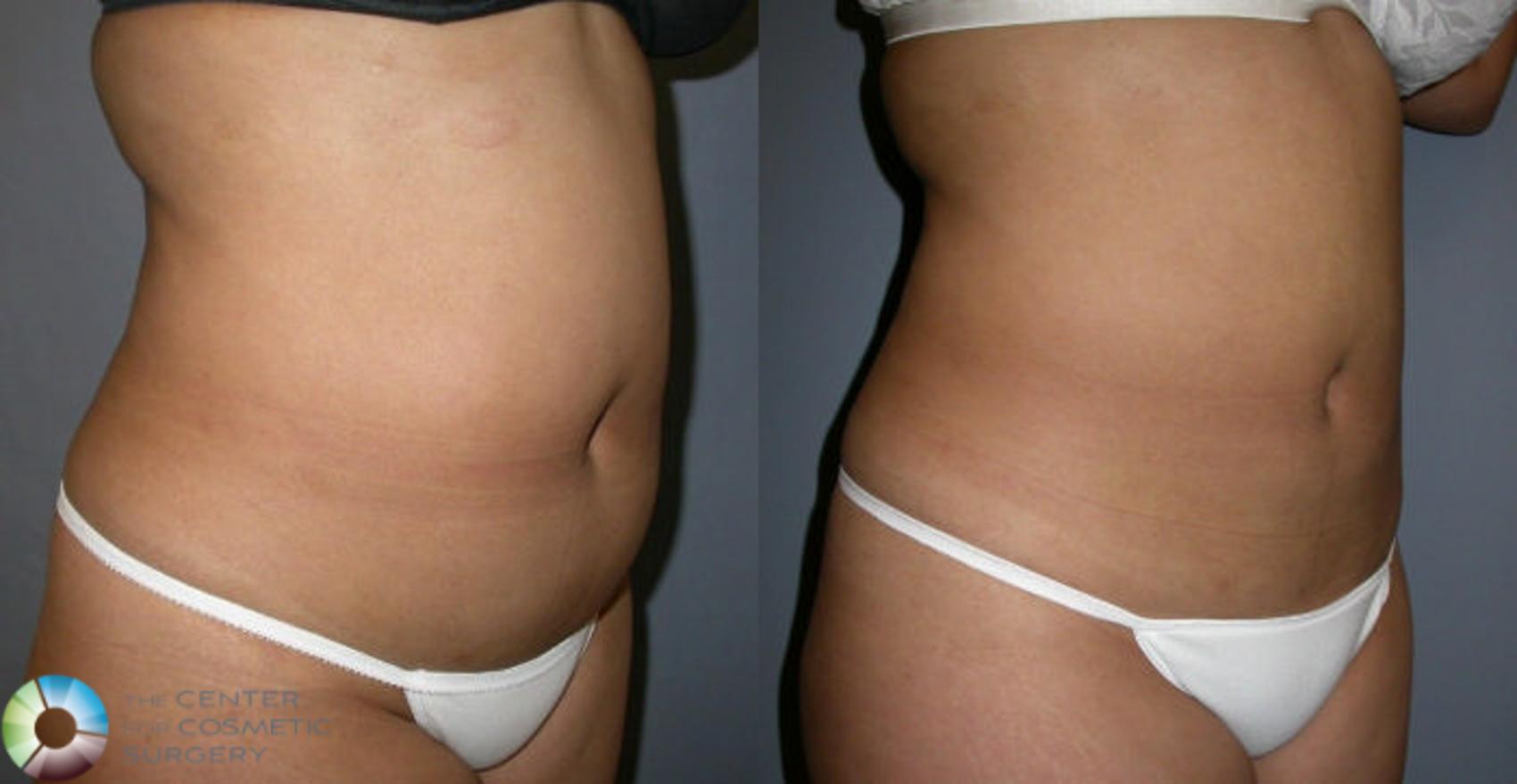 Before & After Power-assisted Liposuction Case 4 View #1 in Denver and Colorado Springs, CO