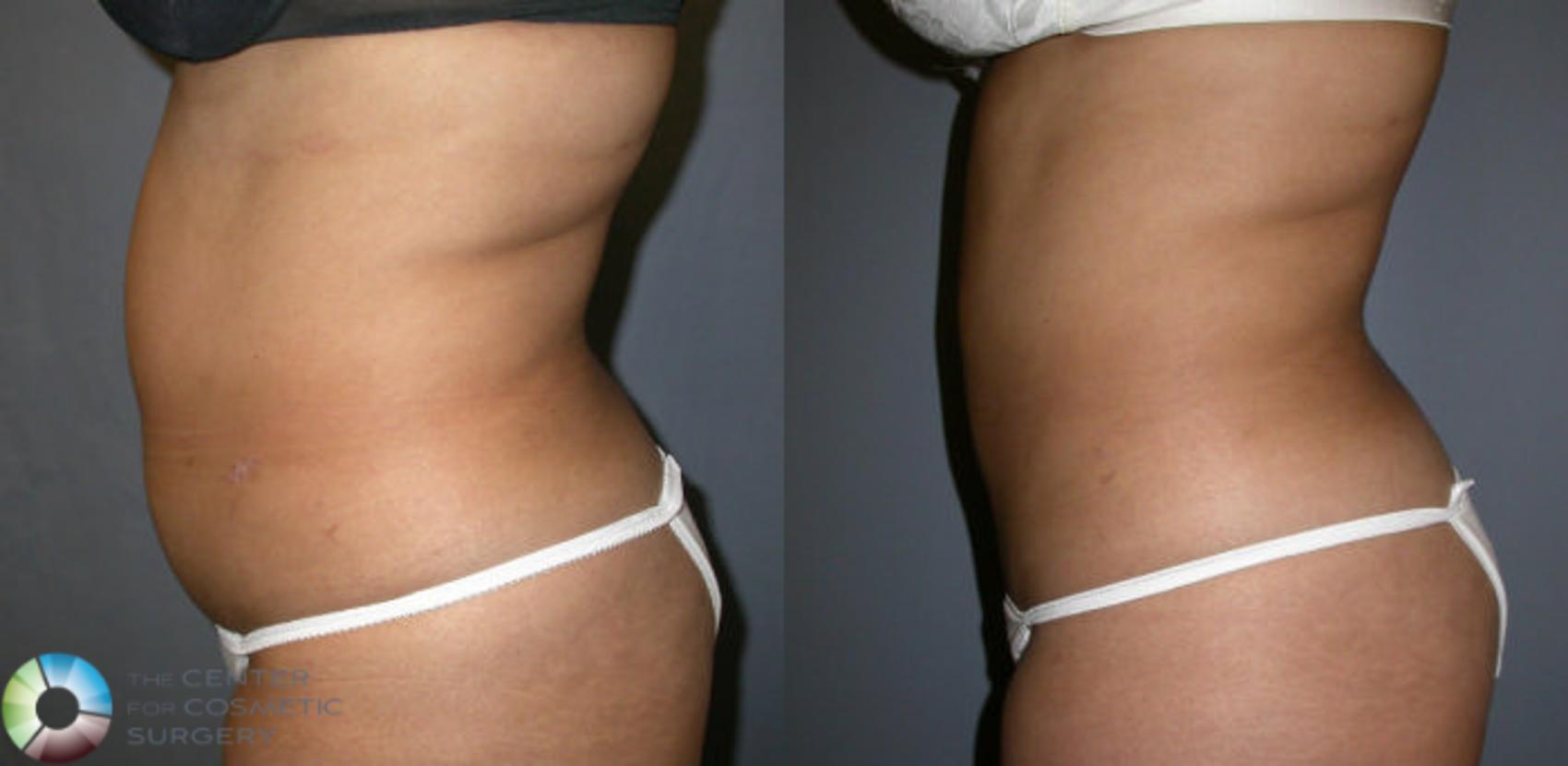Before & After Liposuction Case 4 View #2 in Denver and Colorado Springs, CO