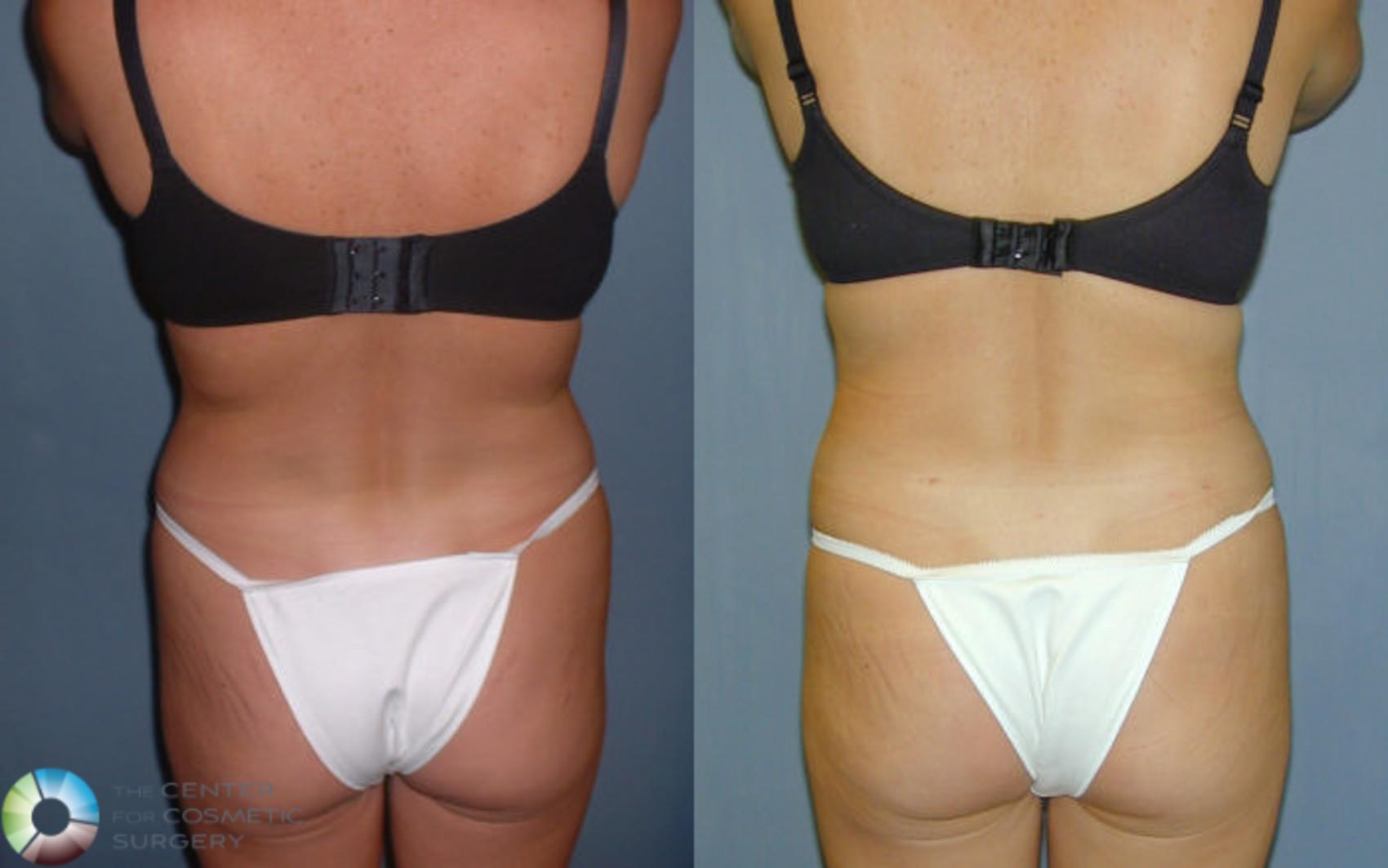 Before & After Power-assisted Liposuction Case 41 View #1 in Denver and Colorado Springs, CO