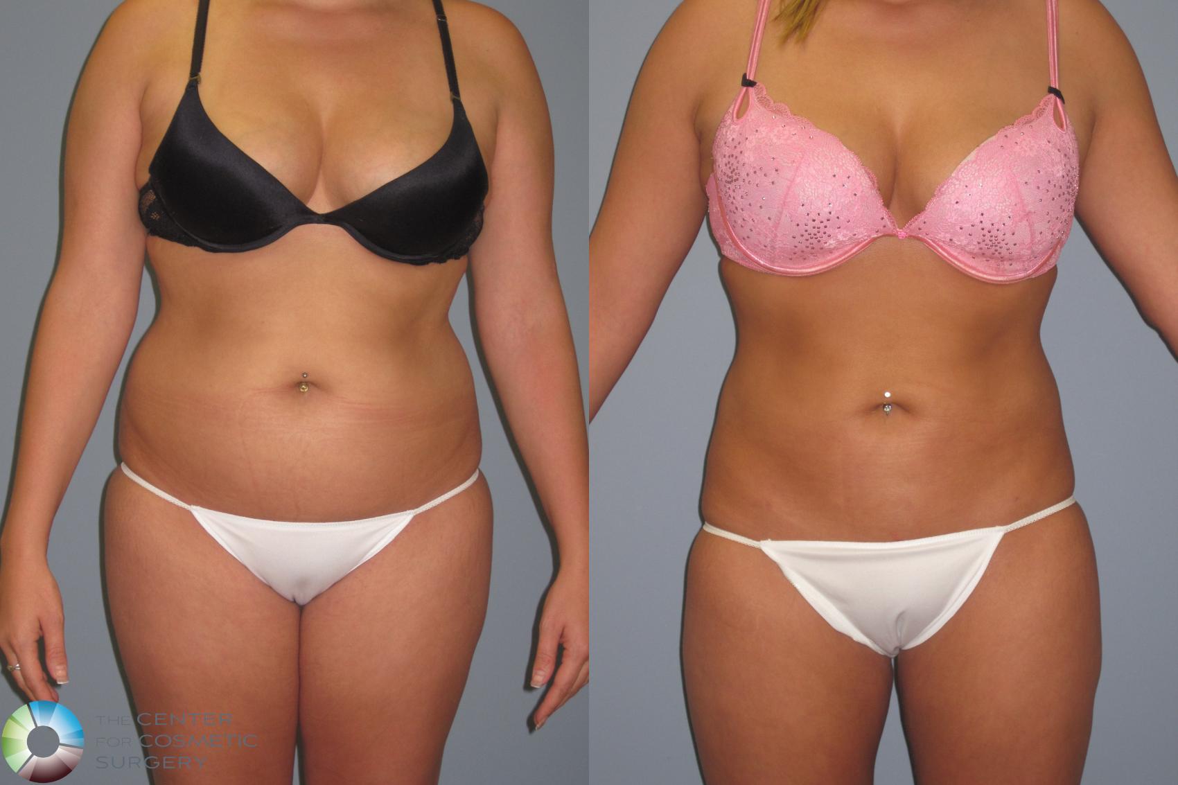 Before & After Liposuction Case 446 View #1 View in Golden, CO