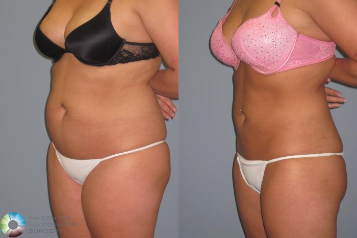 Before & After Liposuction Case 446 View #2 View in Golden, CO