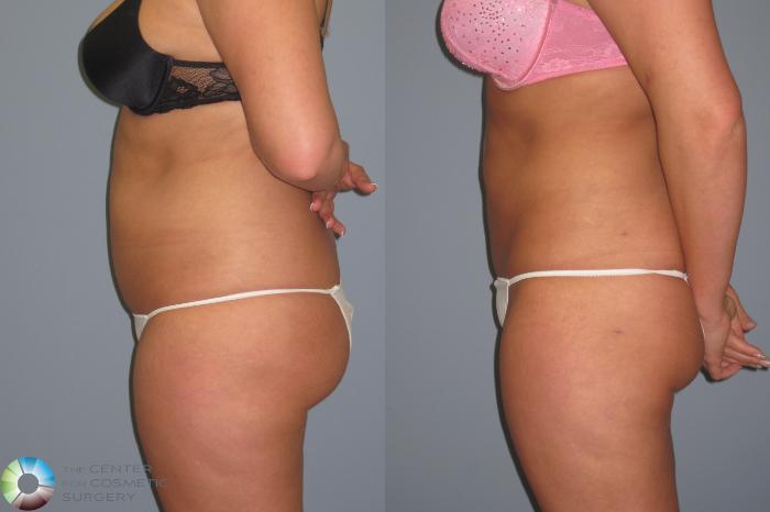 Before & After Liposuction Case 446 View #3 View in Golden, CO