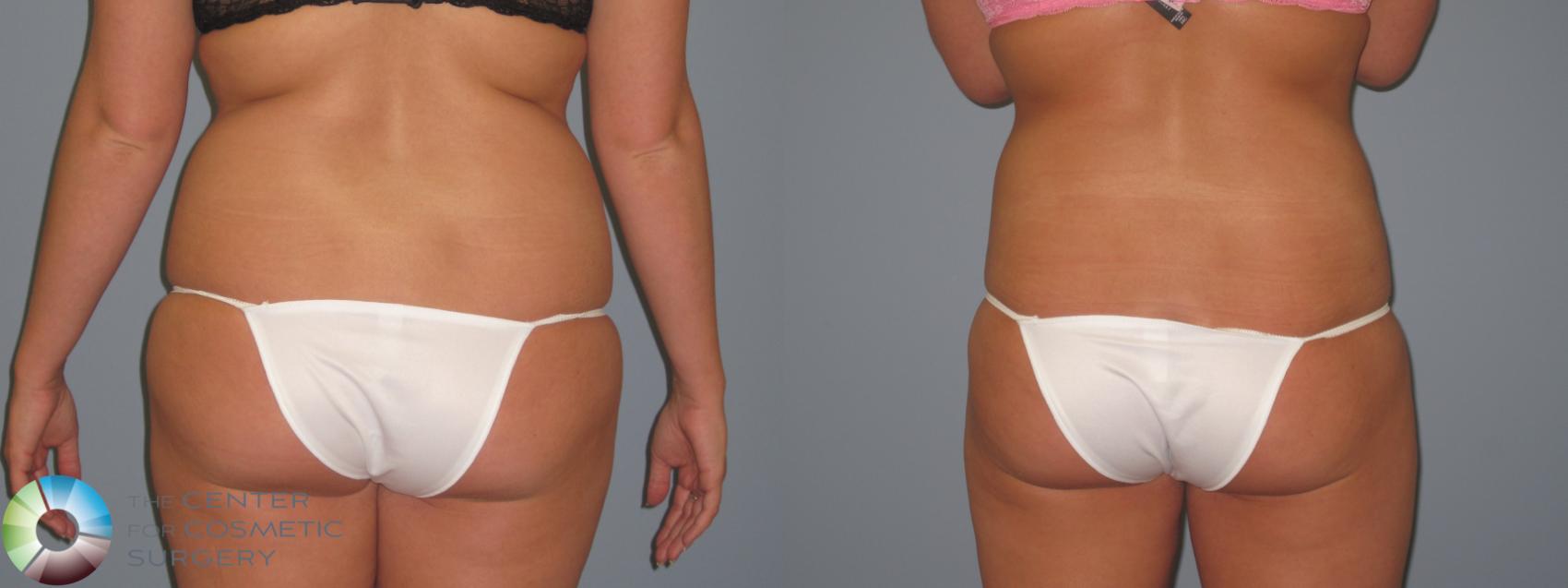 Before & After Power-assisted Liposuction Case 446 View #4 View in Denver & Golden, CO