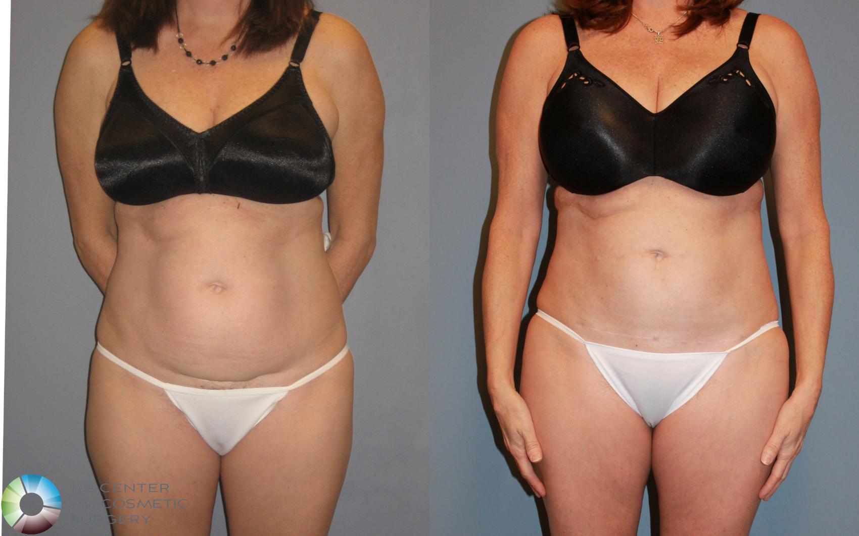 Before & After Power-assisted Liposuction Case 455 View #1 in Denver and Colorado Springs, CO