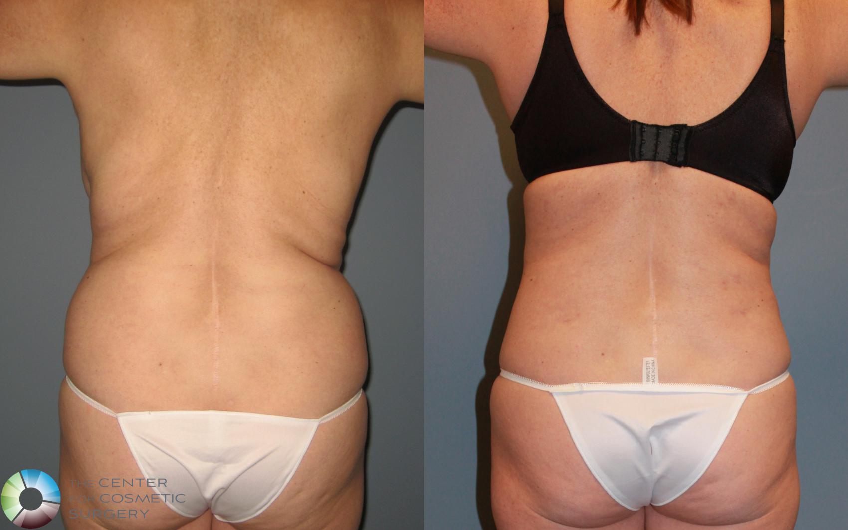 Before & After Liposuction Case 455 View #2 in Denver and Colorado Springs, CO