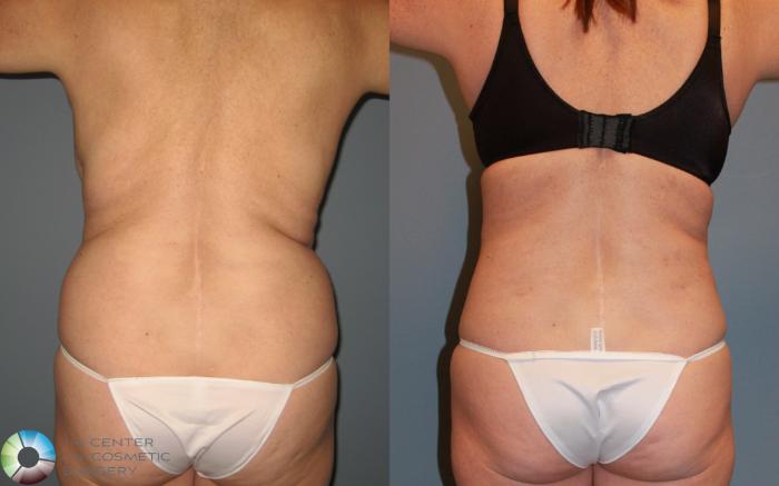 Before & After Power-assisted Liposuction Case 455 View #2 View in Golden, CO