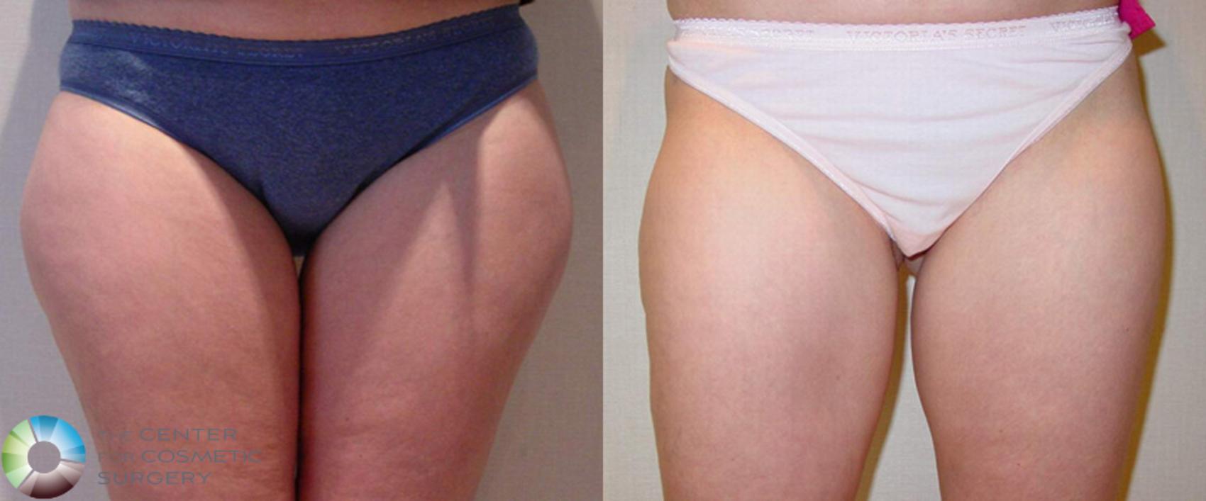 Before & After Liposuction Case 507 View #1 in Denver and Colorado Springs, CO