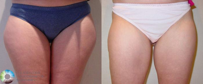 Before & After Liposuction Case 507 View #1 in Denver, CO