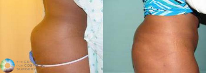 Before & After Liposuction Case 536 View #1 in Denver and Colorado Springs, CO