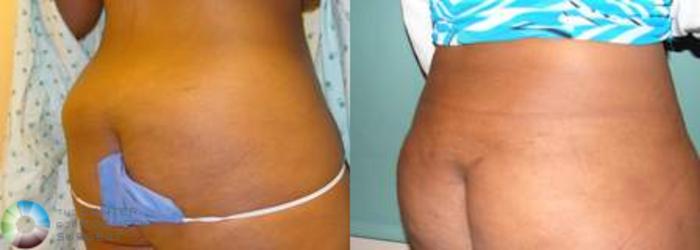 Before & After Liposuction Case 536 View #2 in Denver and Colorado Springs, CO