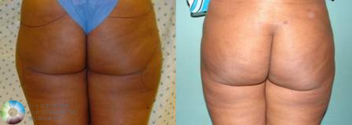 Before & After Liposuction Case 536 View #3 in Denver and Colorado Springs, CO