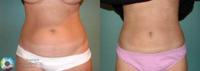Before & After Liposuction Case 537 View #1 View in Golden, CO