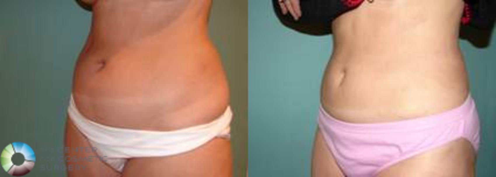 Before & After Liposuction Case 537 View #2 View in Golden, CO