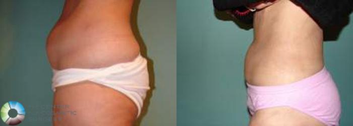 Before & After Liposuction Case 537 View #3 View in Golden, CO