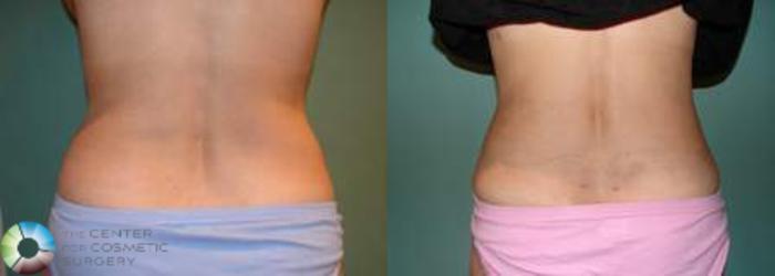 Before & After Liposuction Case 537 View #4 View in Golden, CO