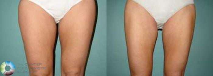 Before & After Liposuction Case 538 View #1 in Denver and Colorado Springs, CO